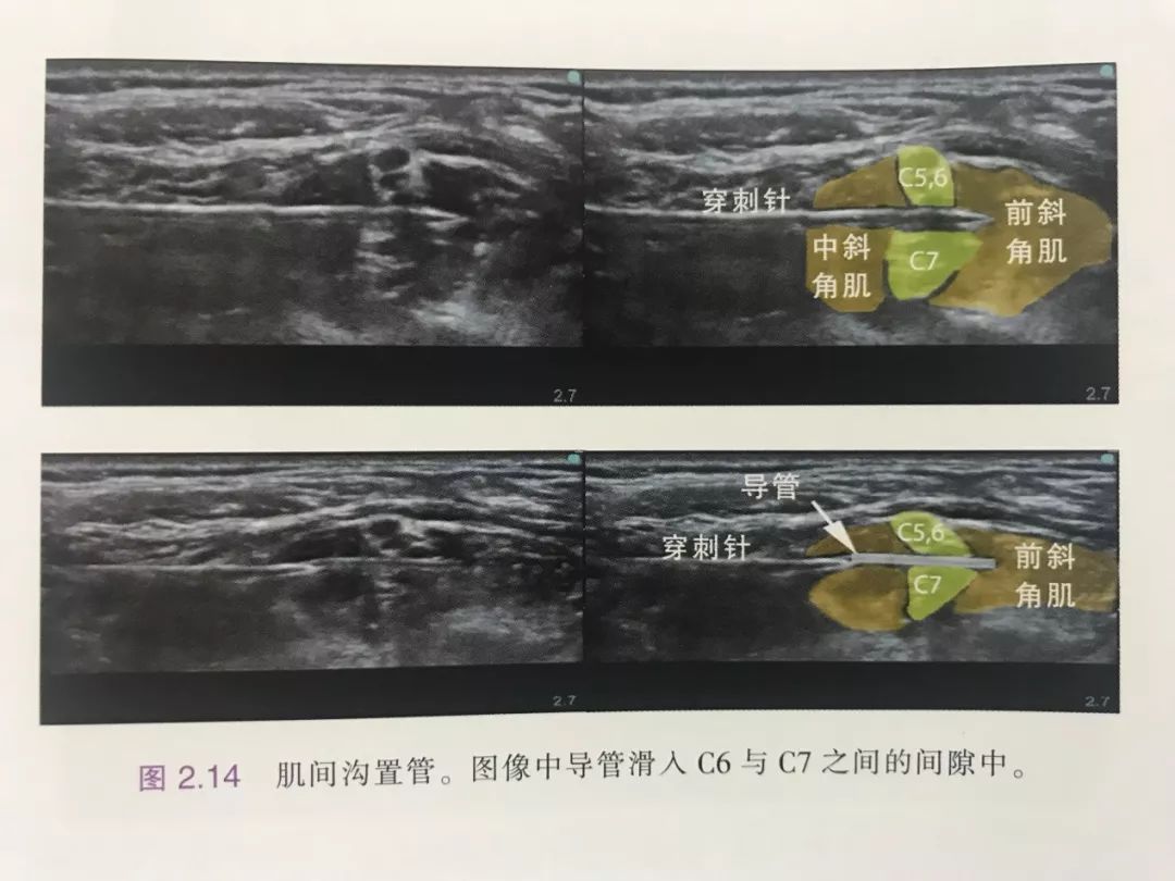 實現精準麻醉之超聲引導下神經阻滯