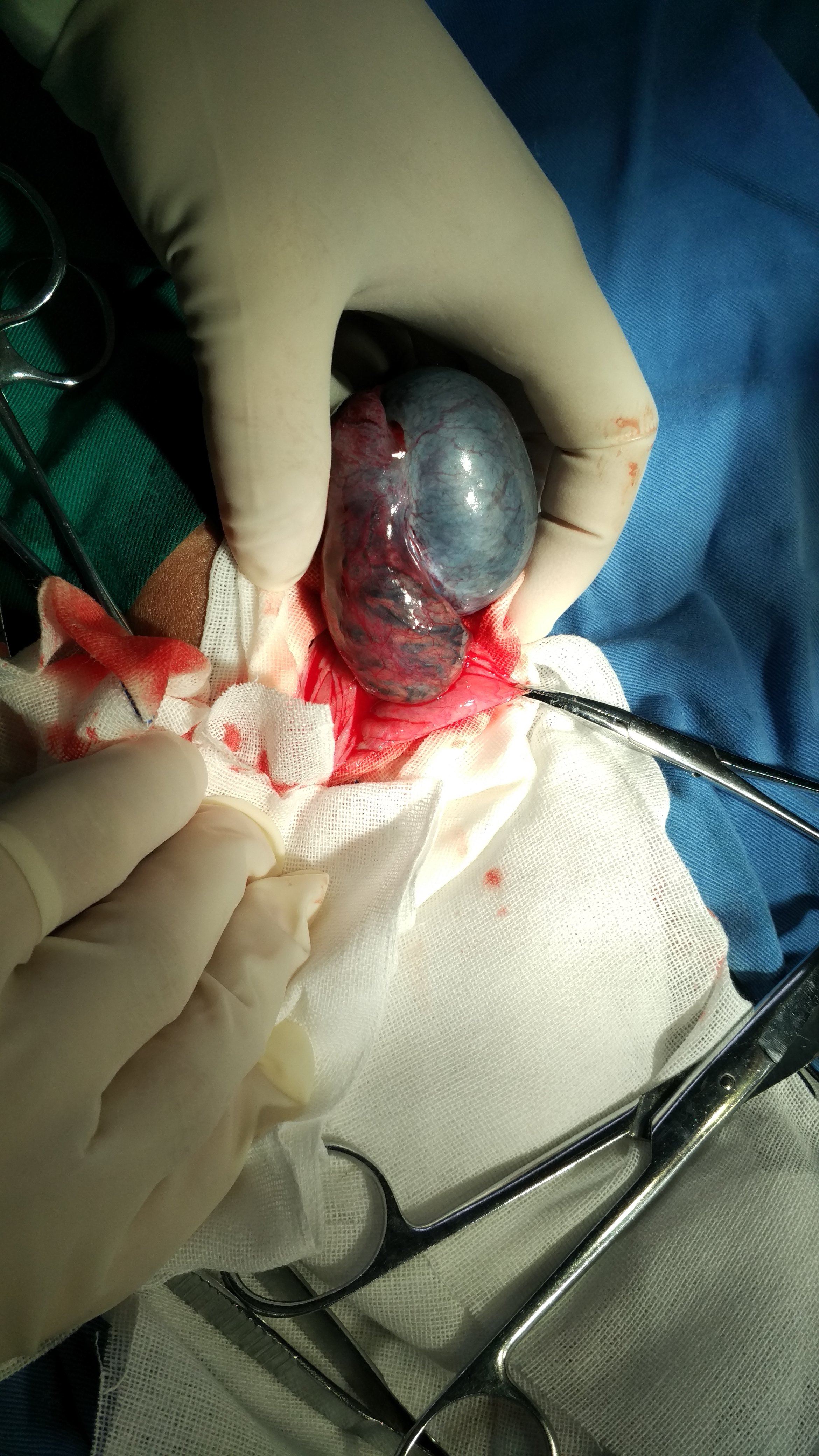 睾丸切除手术图摘除图片