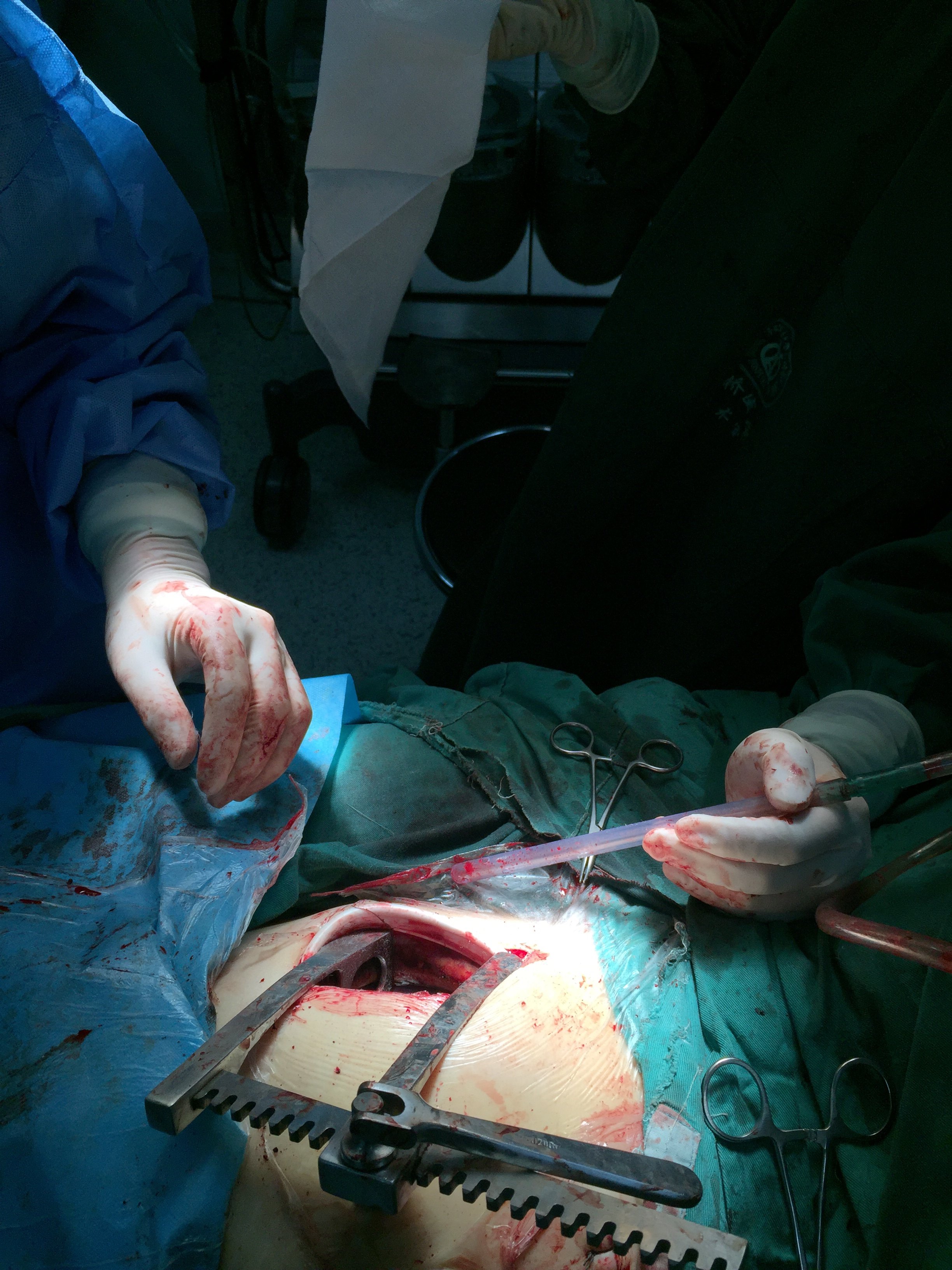 24岁女孩心脏手术图片