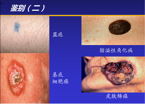 蓝色痣可以点掉吗图片