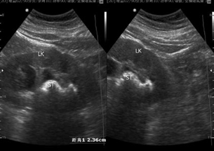 1:b超是目前常规检查尿路结石的方法,无痛无创伤,对x线不显影的结石