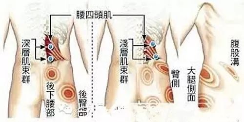 腰骶筋膜脂肪疝图片图片