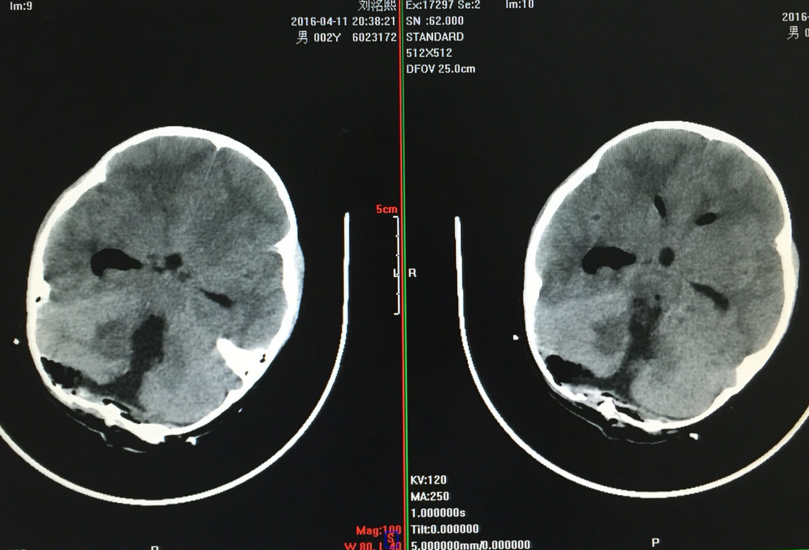 2岁小儿第四脑室巨大恶性肿瘤手术成功