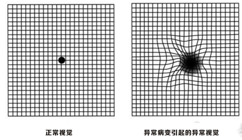 wamd治療進入醫保時代,更少注射,更多獲益_黃斑