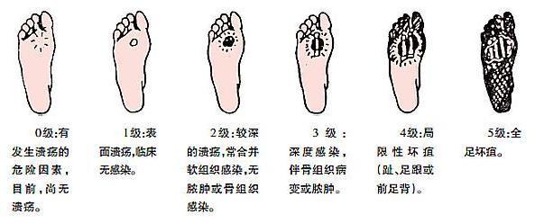 糖尿病足分级以及图片图片