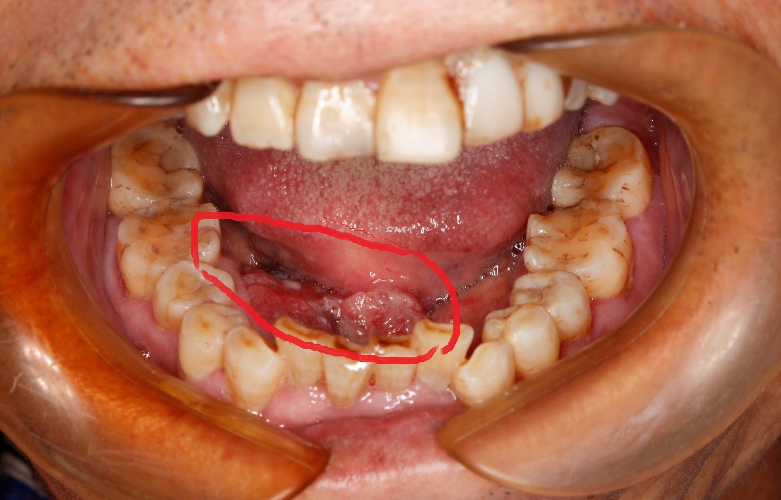 口腔粘液性肿瘤图片图片