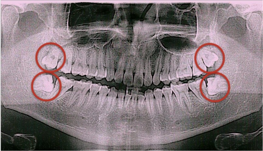 智齿骨骼图片图片