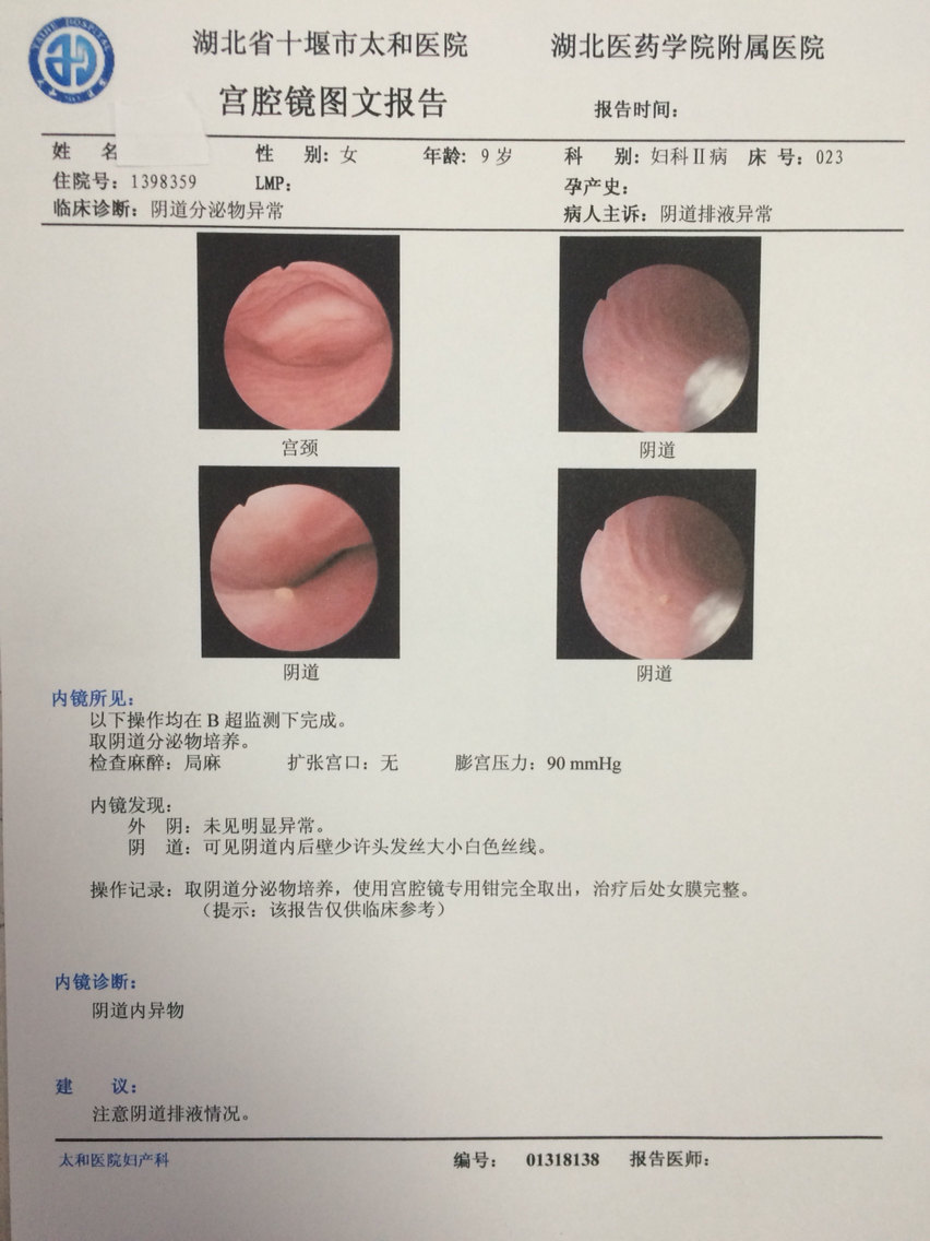 警惕反复发作的幼女阴道炎可能是阴道异物