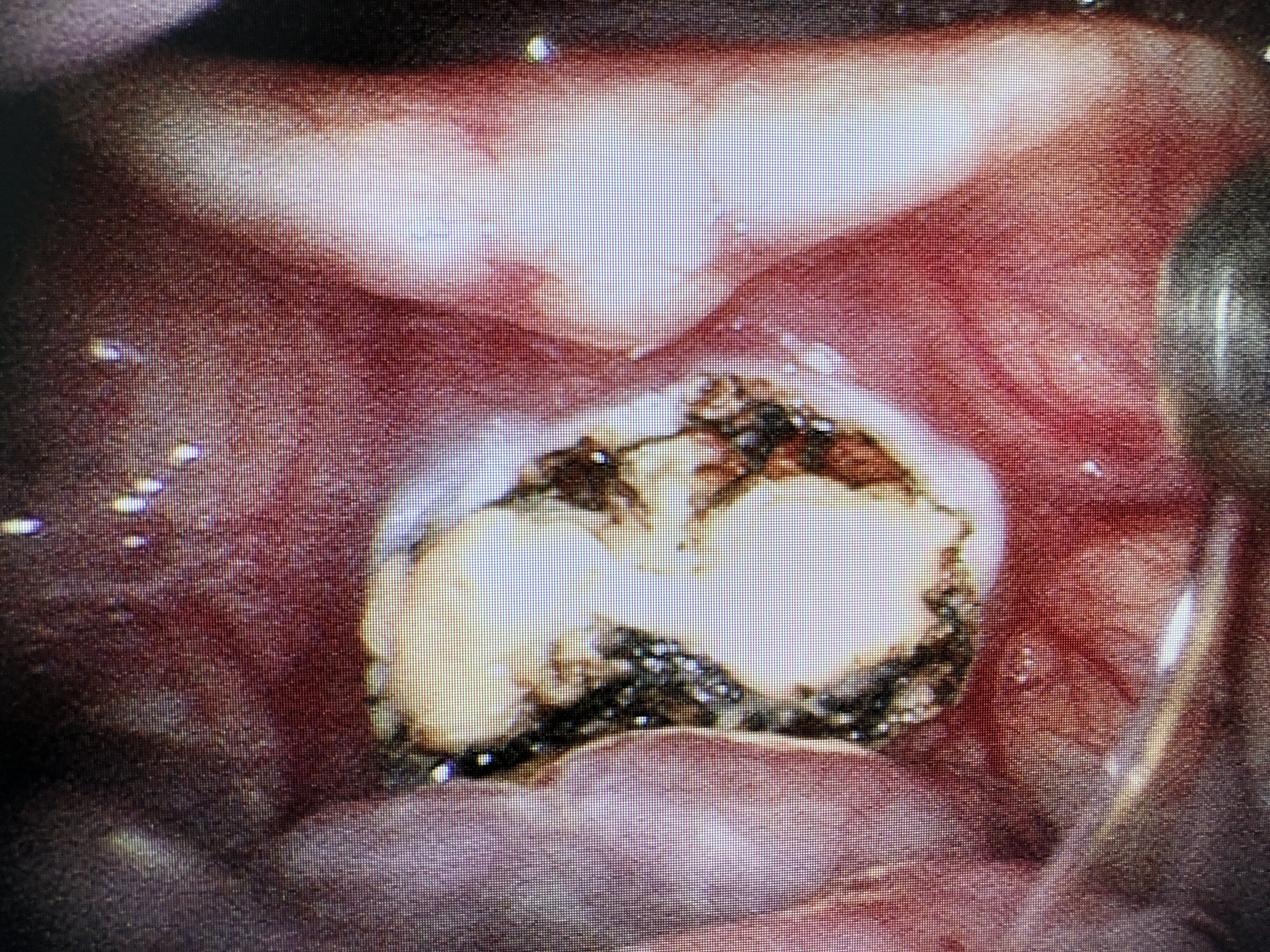 电子喉镜下可以看到会厌舌面中份及偏左两处大小不等囊肿样物