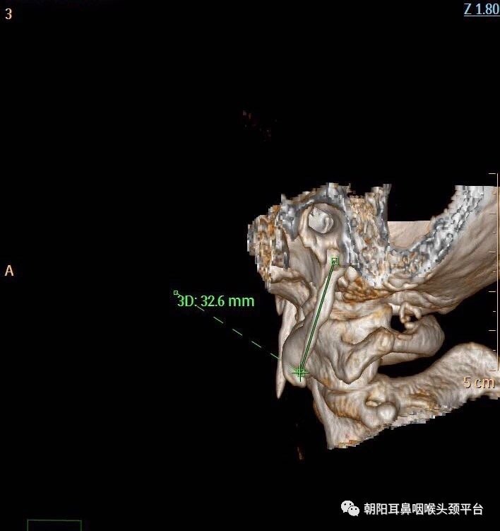 形態異常,或莖突舌骨韌帶鈣化或骨化,以致因莖突遠端位置貼近頸部血管