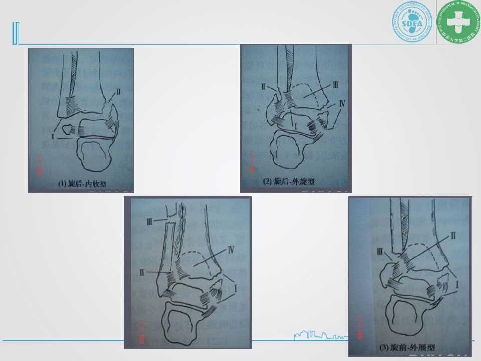 踝关节骨折分型图解图片