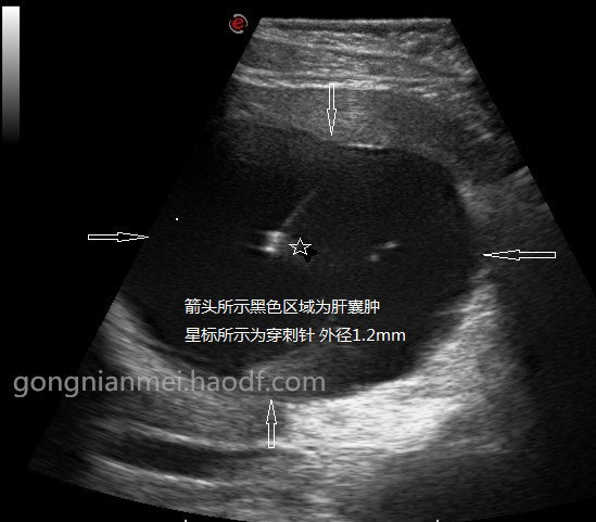 肝囊肿6×5mm图片图片