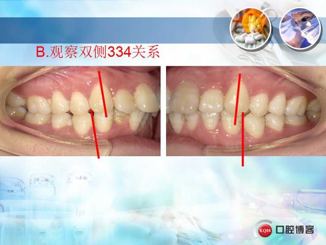 尖牙一类关系图片