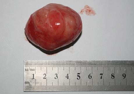 乳腺纤维瘤真人图片