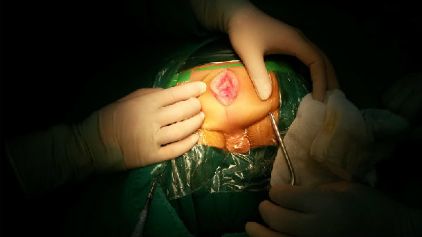 小孩肛门手术图片