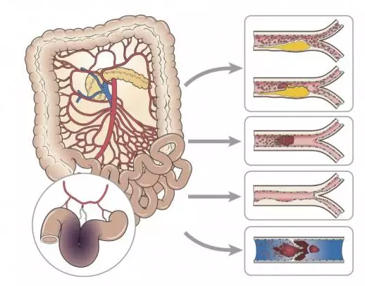 图说肠系膜动脉缺血