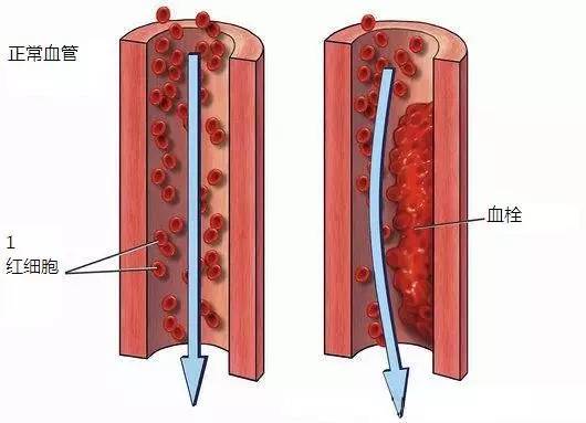 心脏流血血栓图片