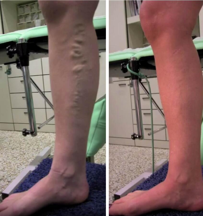chiva传奇:下肢静脉曲张的极致微创手术,保留大隐静脉
