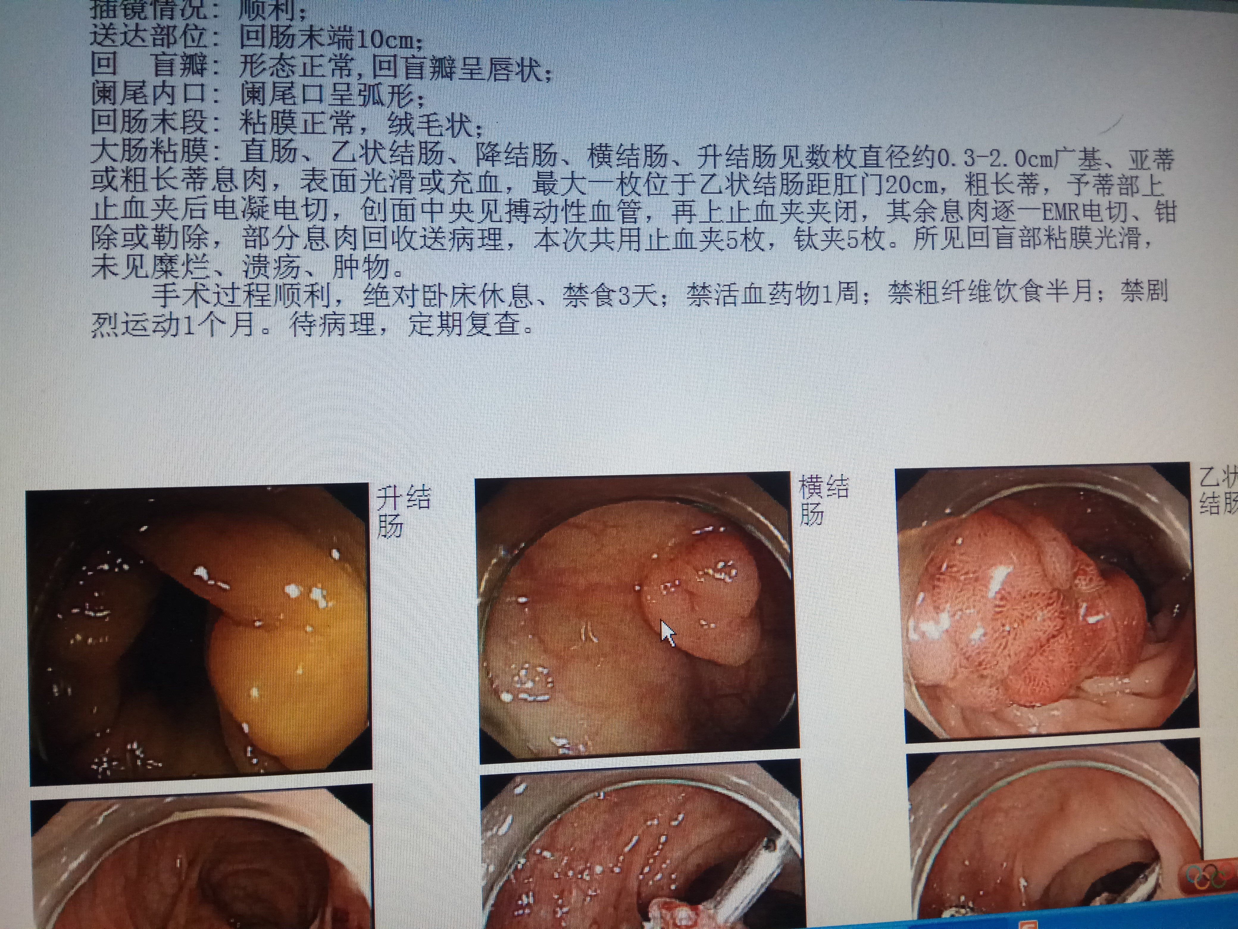 肛周膿腫行直乙腸鏡病例分享_檢查