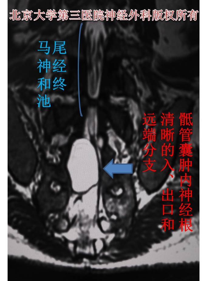 骶管囊肿新分型不再倒推