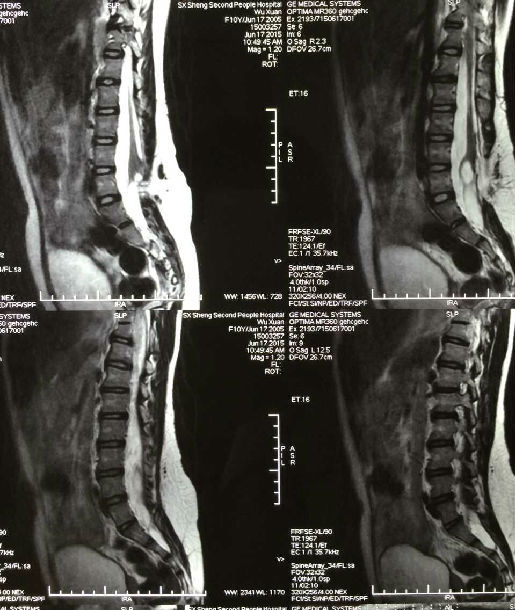 脊柱裂核磁图片