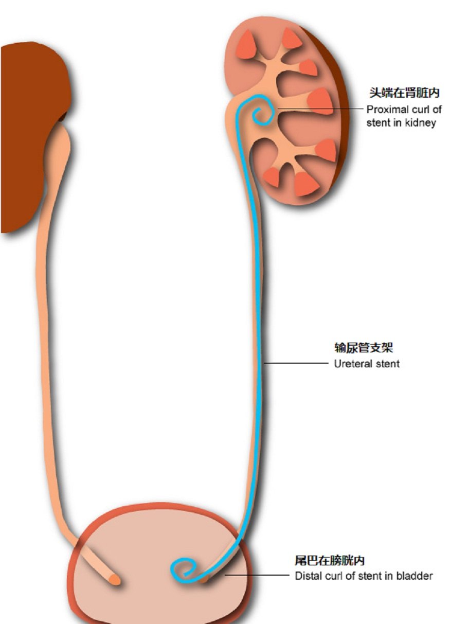 输尿管支架不良反应图片