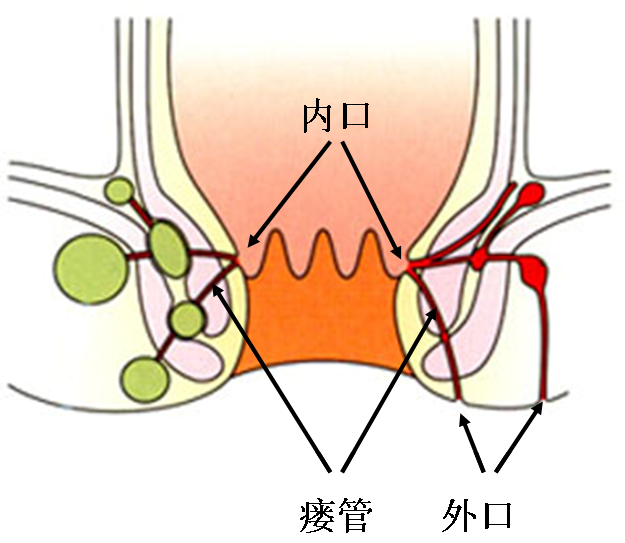 當肛裂發生在非典型位置或發現多個裂縫時,應該檢查是否存在其他潛在