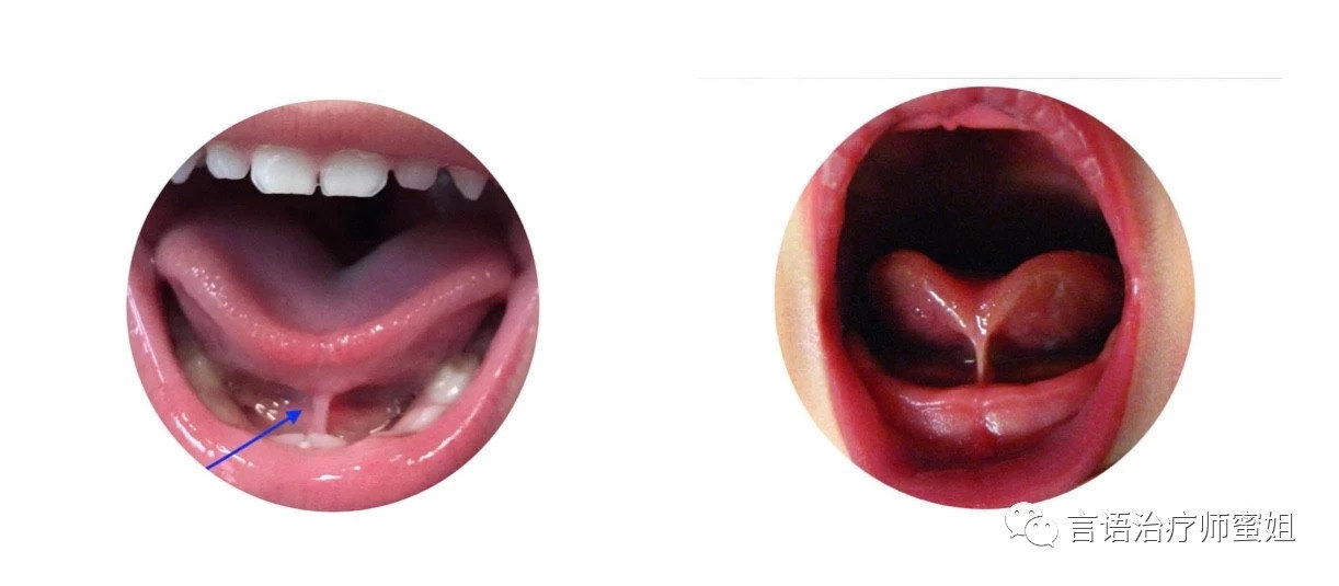 舌系带短的表现图片图片