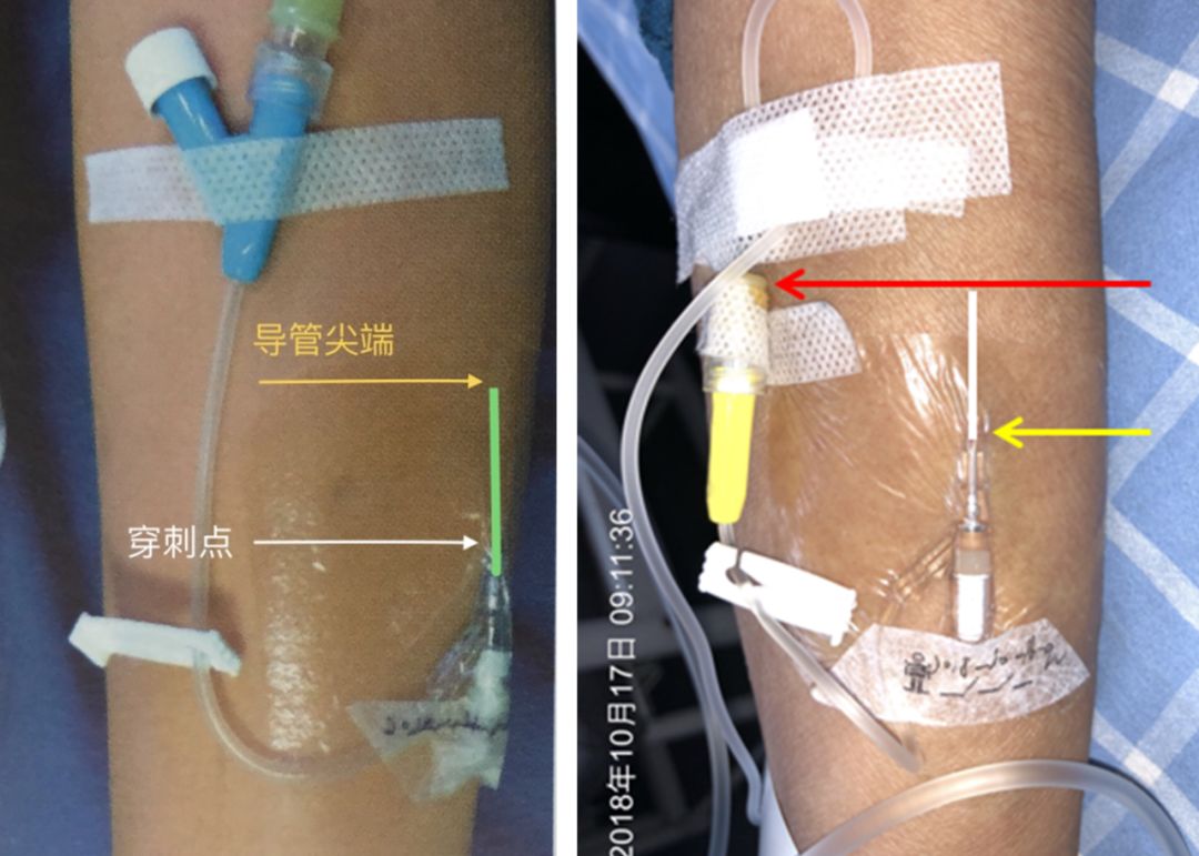 留置针u型固定图片