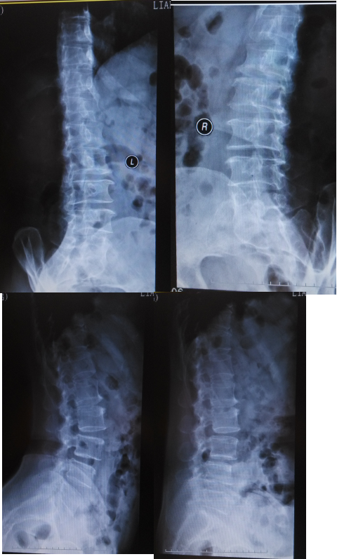 腰椎退行性变,l3/4,l4/5,l5/s1椎间隙变窄,l3,l4不稳,未见椎弓峡部裂