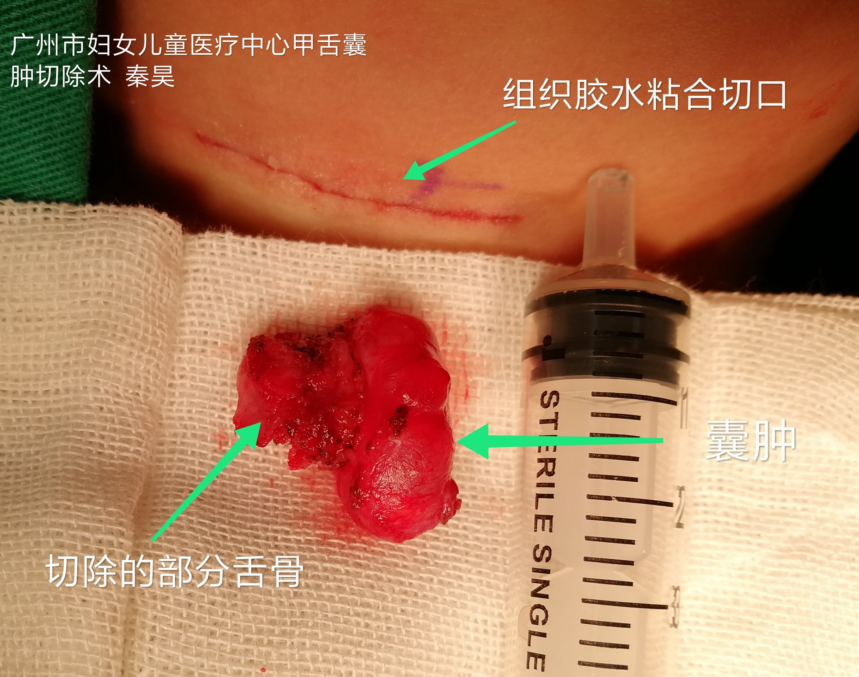 甲状舌骨囊肿刀口图片图片