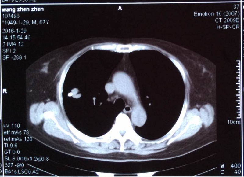 右肺結節消失了瘢痕癌的陀螺刀治療