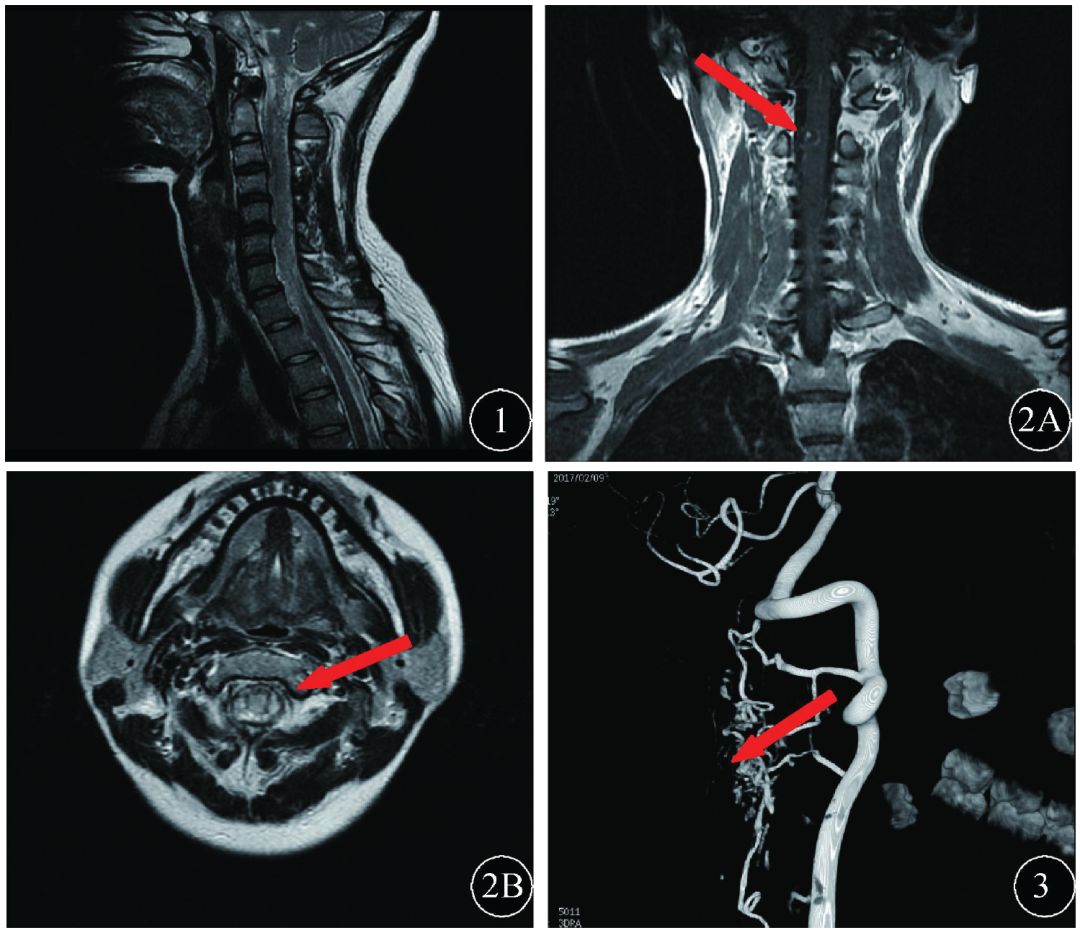 误诊为急性脊髓炎的高颈段血管畸形1例
