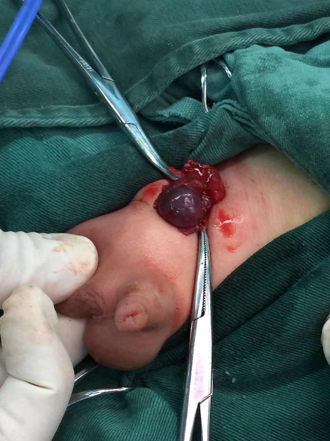 婴儿睾丸照片图片