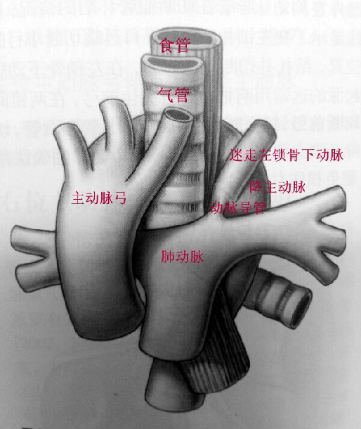 由于右位主动脉弓引起的血管环较为宽松,绝大多数病例并不会压迫气管