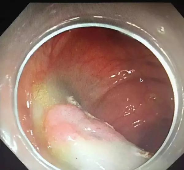 结肠良性肿瘤内镜下微创切除