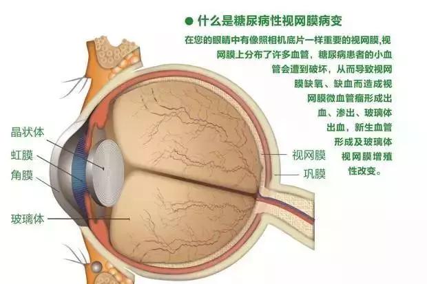 白內障,新生血管性青光眼,糖尿病性視神經病變,視網膜黃斑水腫等,其中