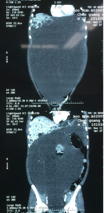 肝血管瘤b超图片