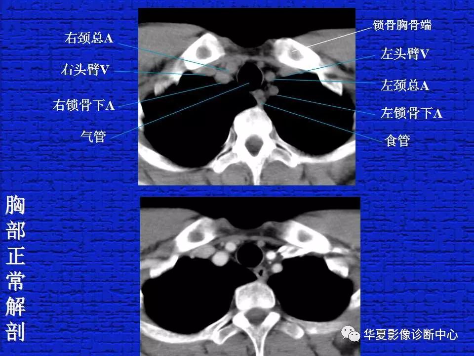 結合解剖學習正常胸部ct