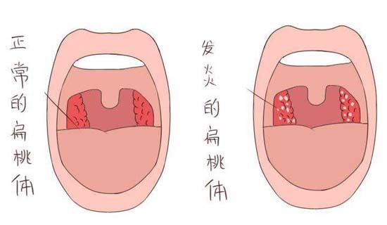 儿童扁桃体角化症图片图片