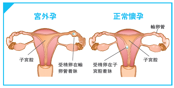 宫外孕图片示意图腹部图片