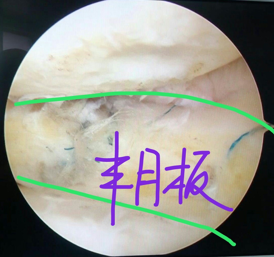 四種半月板縫合技術徹底解決半月板縫合難題