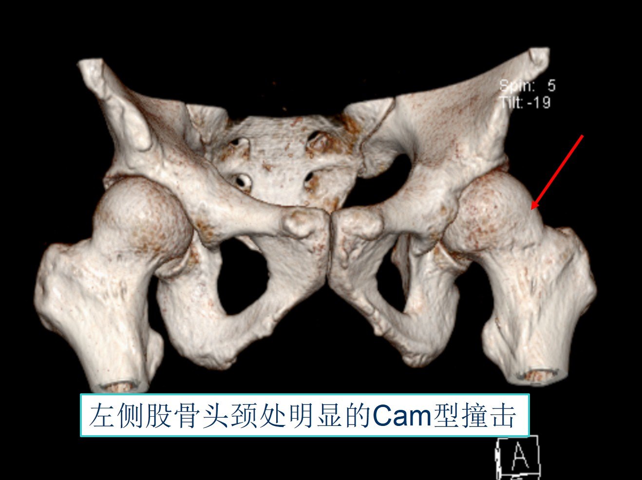 診斷髖關節撞擊(fai),左側症狀嚴重故在全麻下先行左側髖關節鏡