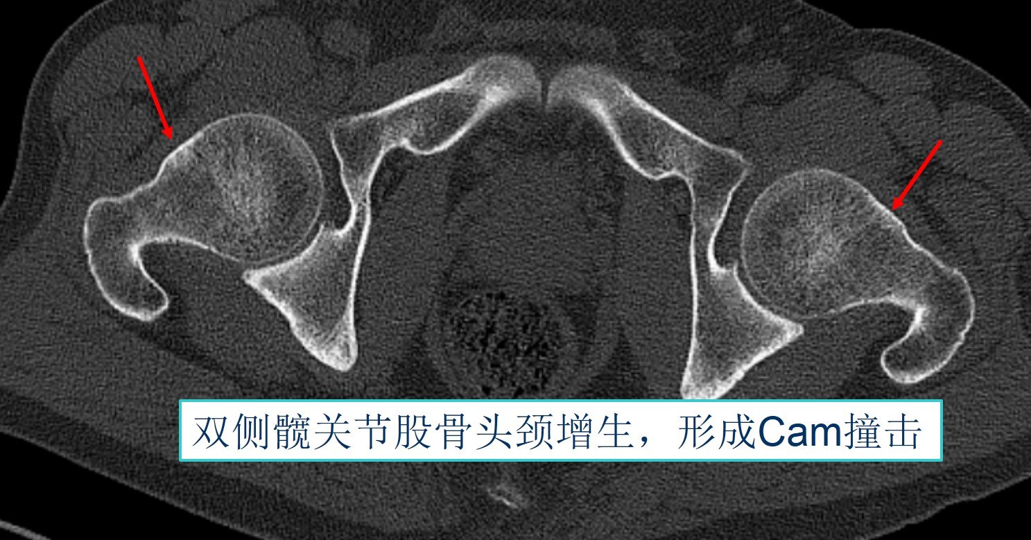 髋臼ce角正常值图片