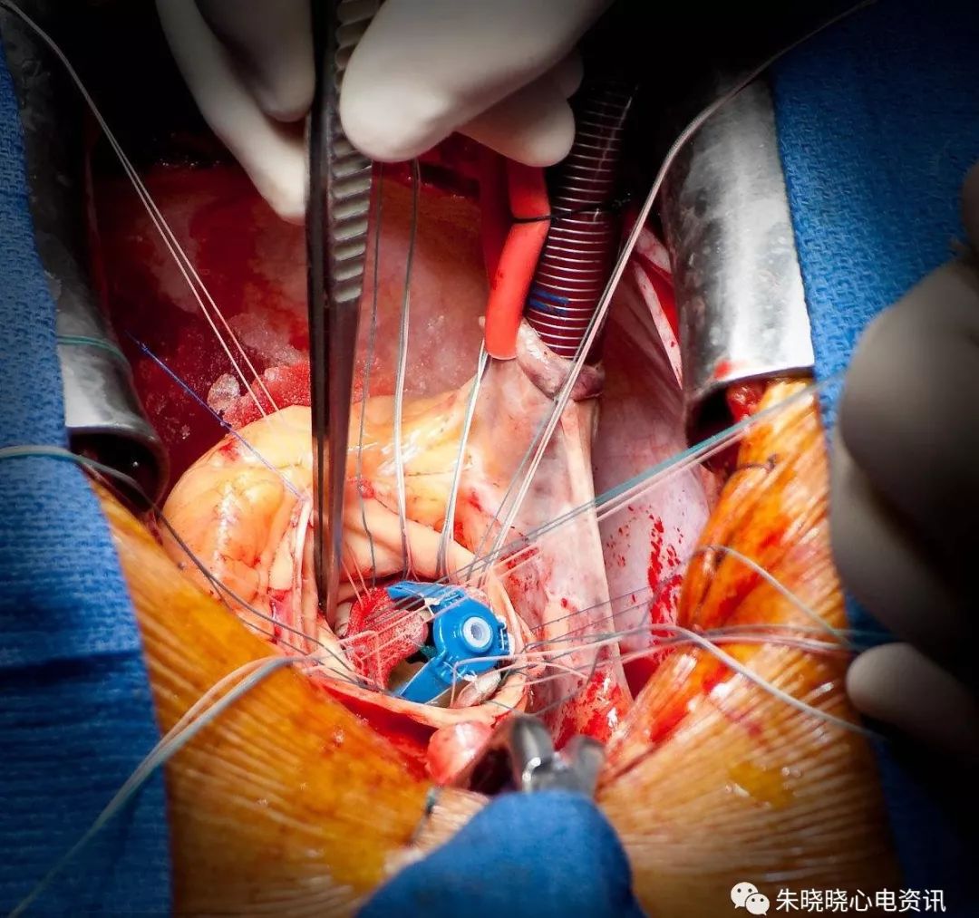 心血管系统之瓣膜置换术3d动画演示