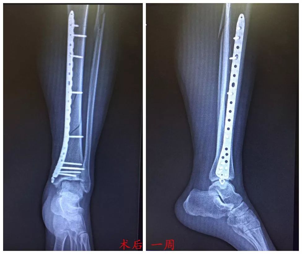 我們的微創之路脛腓骨骨折微創經皮鋼板內固定mpo術