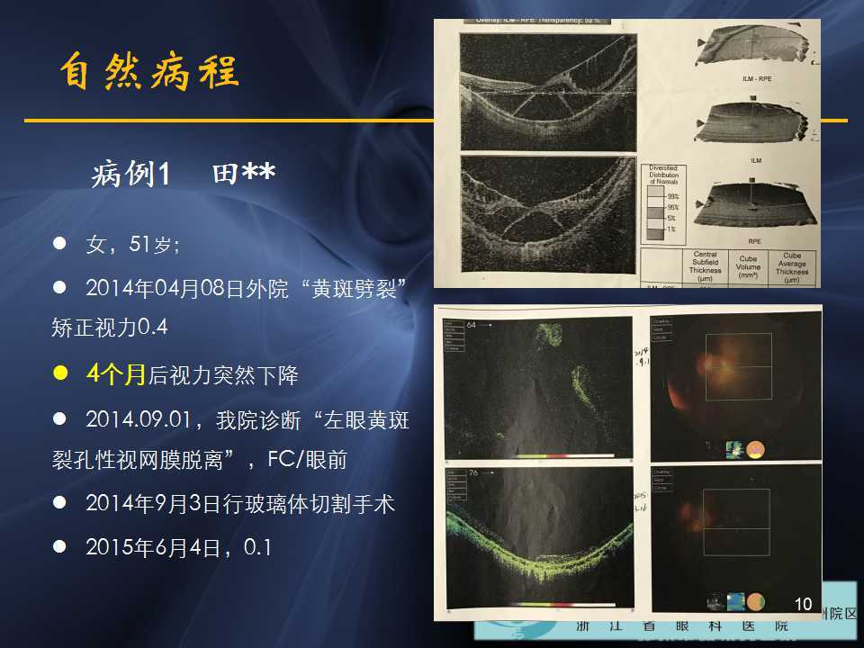 高度近視黃斑劈裂