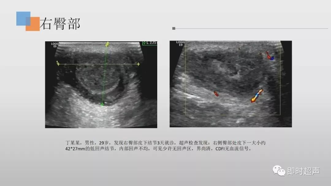 表皮样囊肿超声表现图片