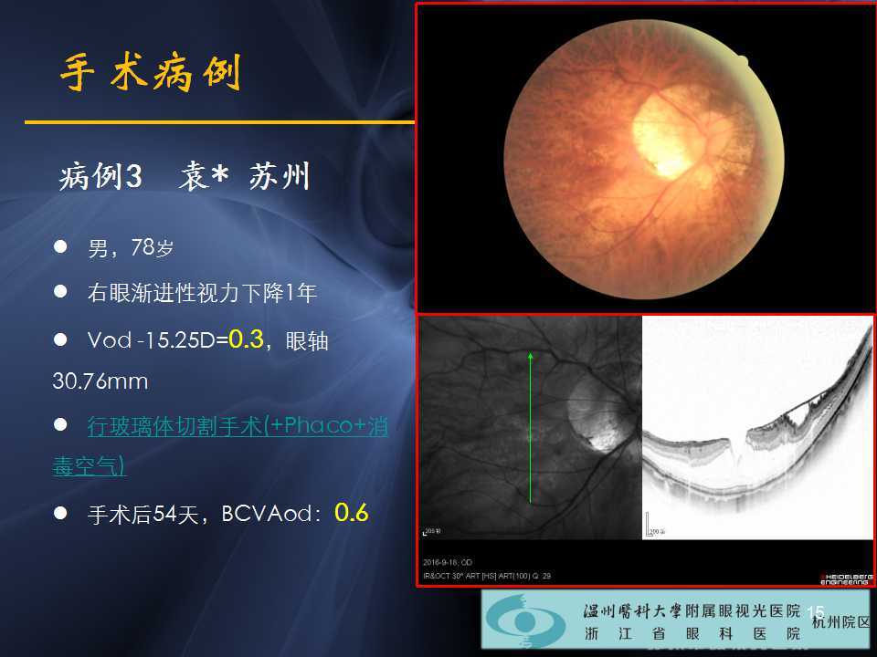 一隻眼睛出現了黃斑裂孔性視網膜脫離,在上海某醫院就診,說不能手術