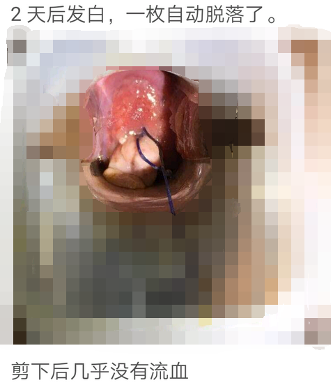宫颈息肉的真实图片图片